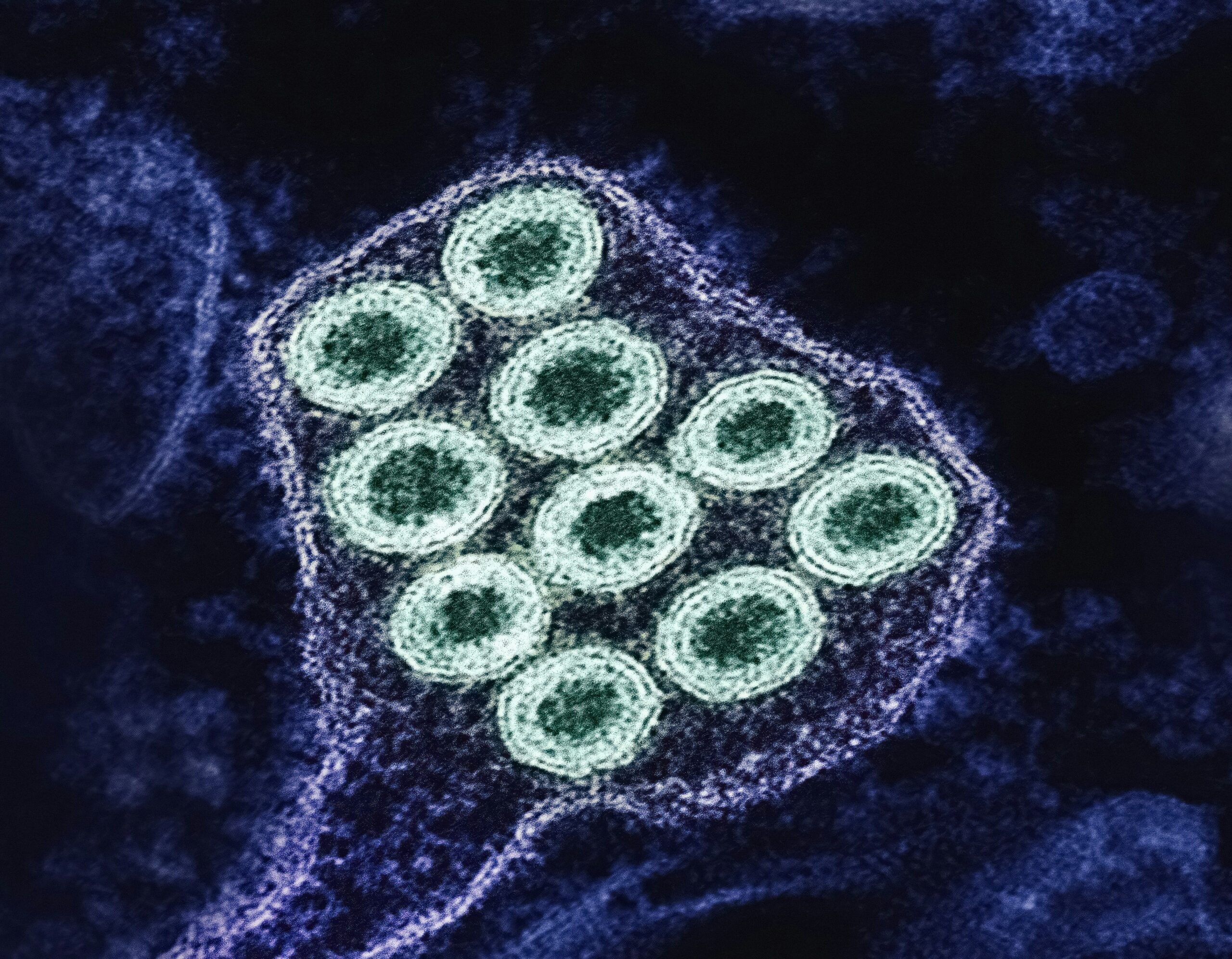 5 Ways to Prevent Norovirus Infections